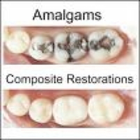 Gold And Amalgam Fillings - Westerville Dental Associates