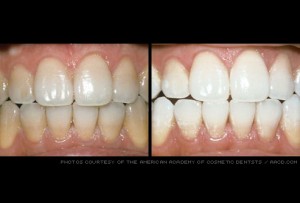 Before and after- Veneers
